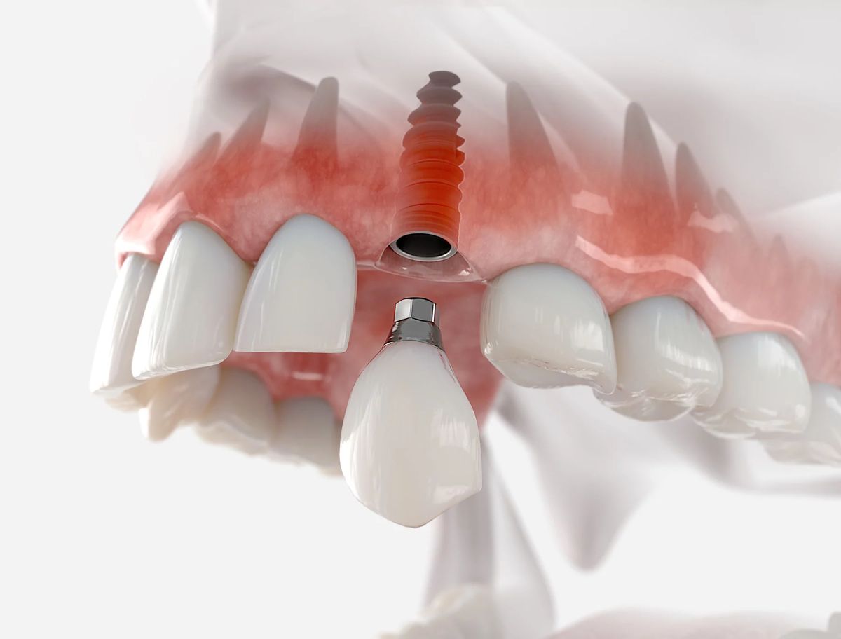 trồng răng implant yenle dental